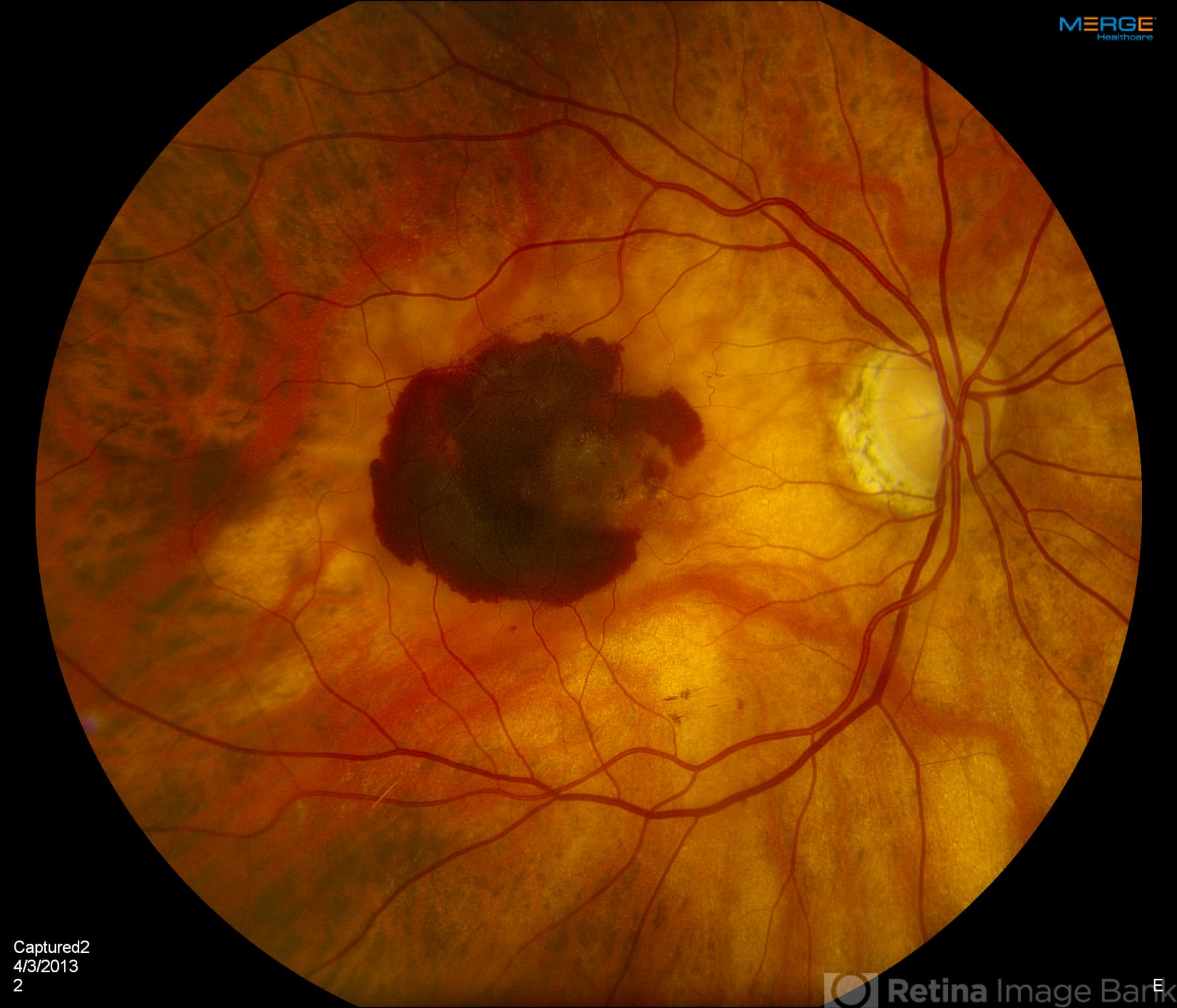 Retina photograph showing the dark central lesion of advanced macular degeneration